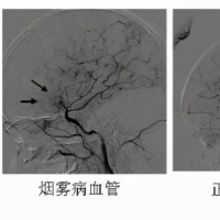 “河南經(jīng)驗”寫入最新煙霧病中國專家共識