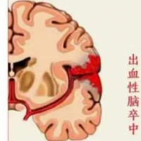 世界卒中日丨提前發(fā)現(xiàn)“卒”絲馬跡